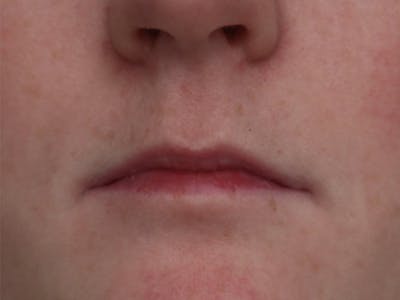 Lip Filler Before & After Gallery - Patient 87552100 - Image 1