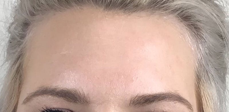 BOTOX Before & After Gallery - Patient 87552106 - Image 4