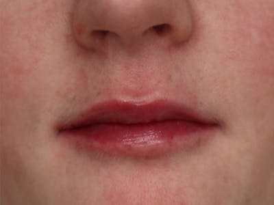 Lip Filler Before & After Gallery - Patient 87552100 - Image 2