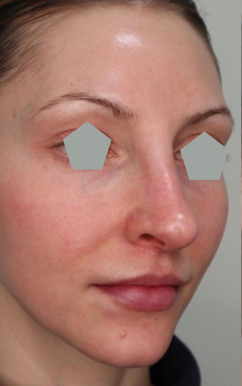 Liquid Rhinoplasty Before & After Gallery - Patient 87552101 - Image 1