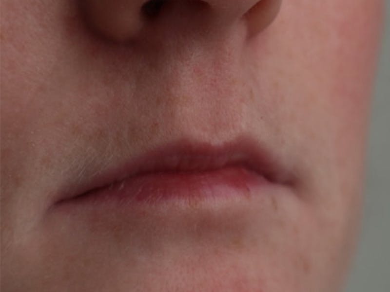 Lip Filler Before & After Gallery - Patient 87552100 - Image 3