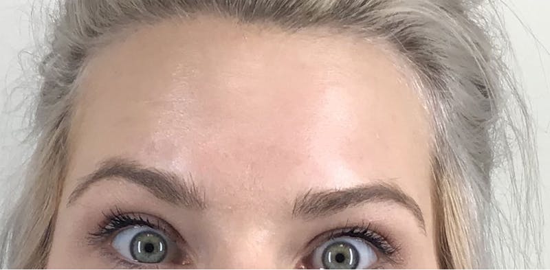 BOTOX Before & After Gallery - Patient 87552106 - Image 6