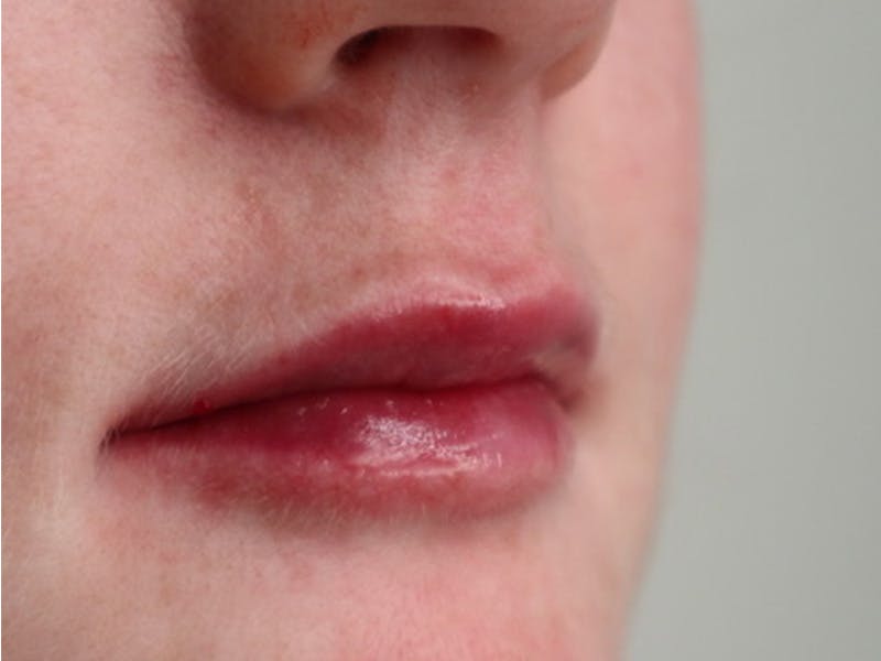 Lip Filler Before & After Gallery - Patient 87552100 - Image 4