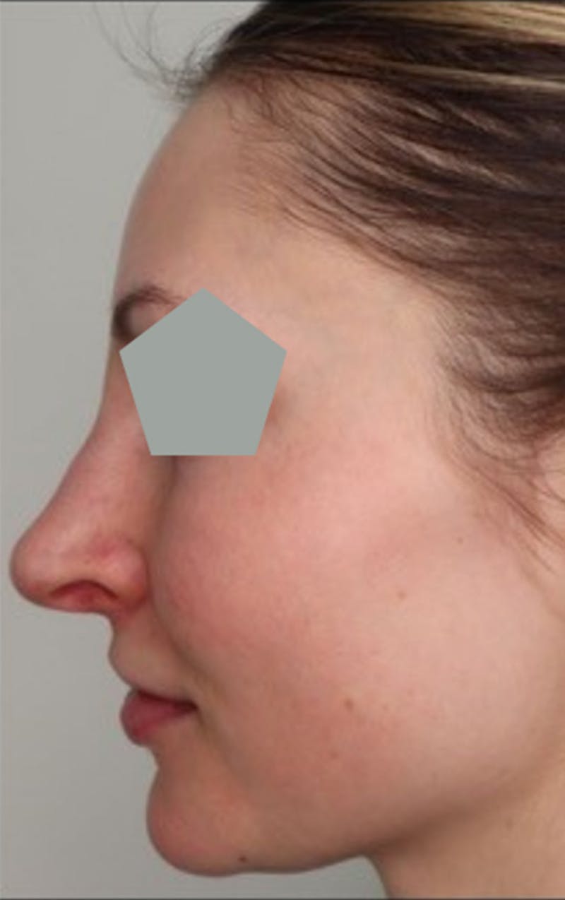Liquid Rhinoplasty Before & After Gallery - Patient 87552101 - Image 3