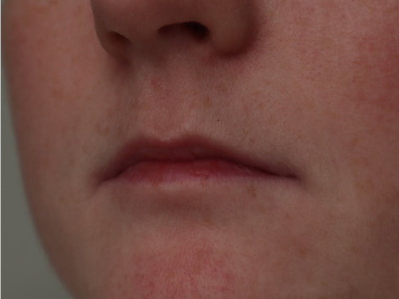 Lip Filler Before & After Gallery - Patient 87552100 - Image 5