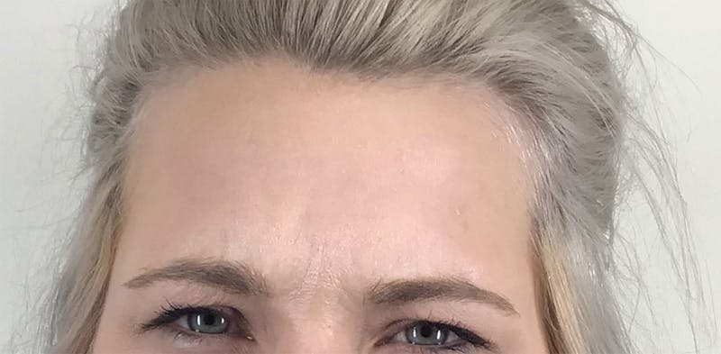 BOTOX Before & After Gallery - Patient 87552106 - Image 8