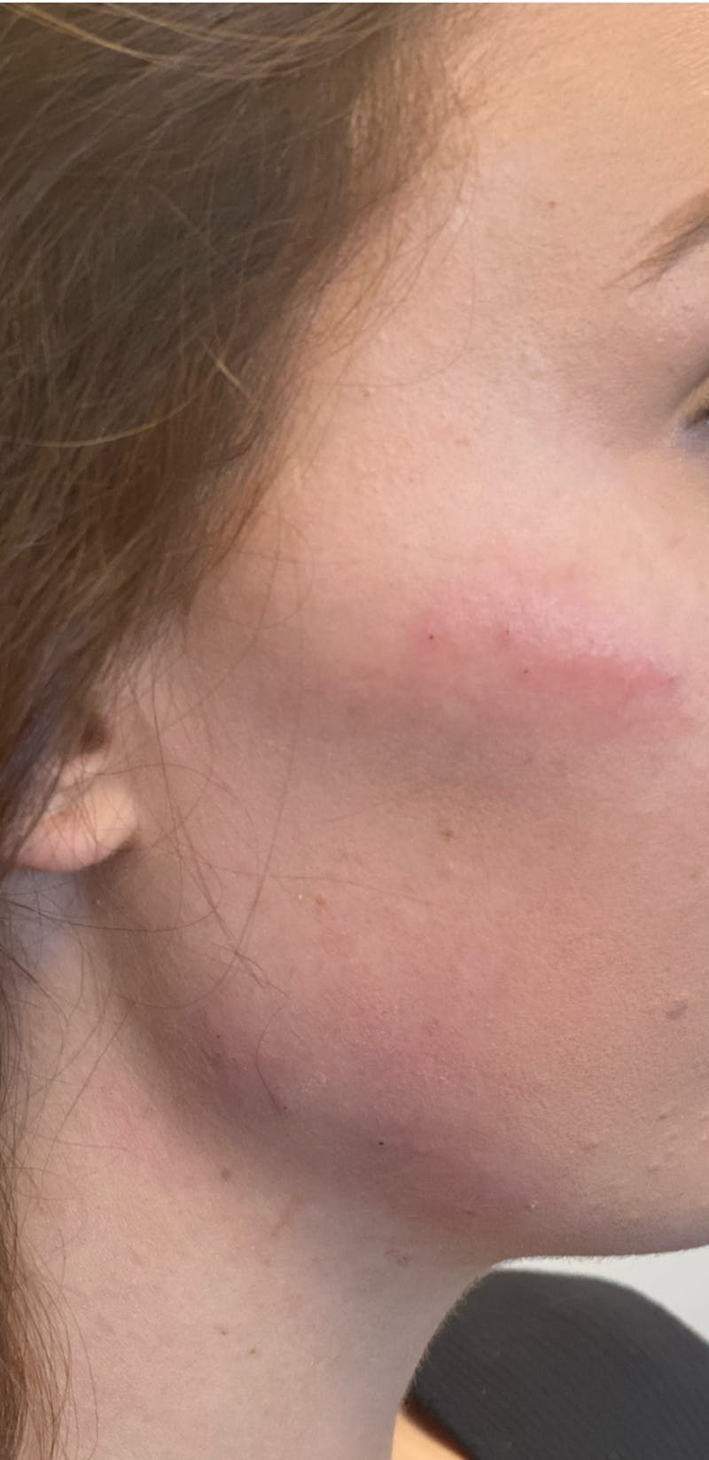 Liquid Lift Before & After Gallery - Patient 87552102 - Image 2