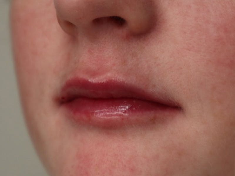 Lip Filler Before & After Gallery - Patient 87552100 - Image 6