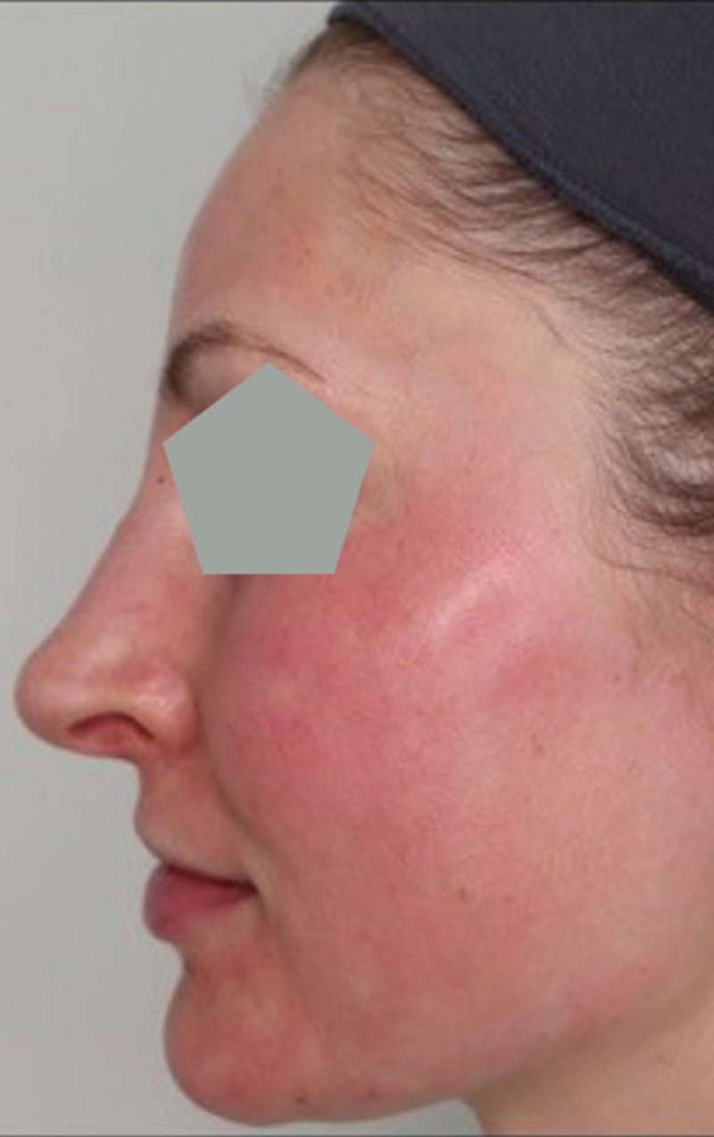 Liquid Rhinoplasty Before & After Gallery - Patient 87552101 - Image 4