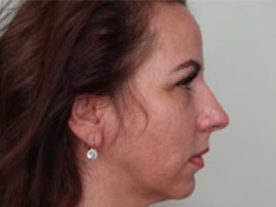 Lip Filler Before & After Gallery - Patient 87552105 - Image 1