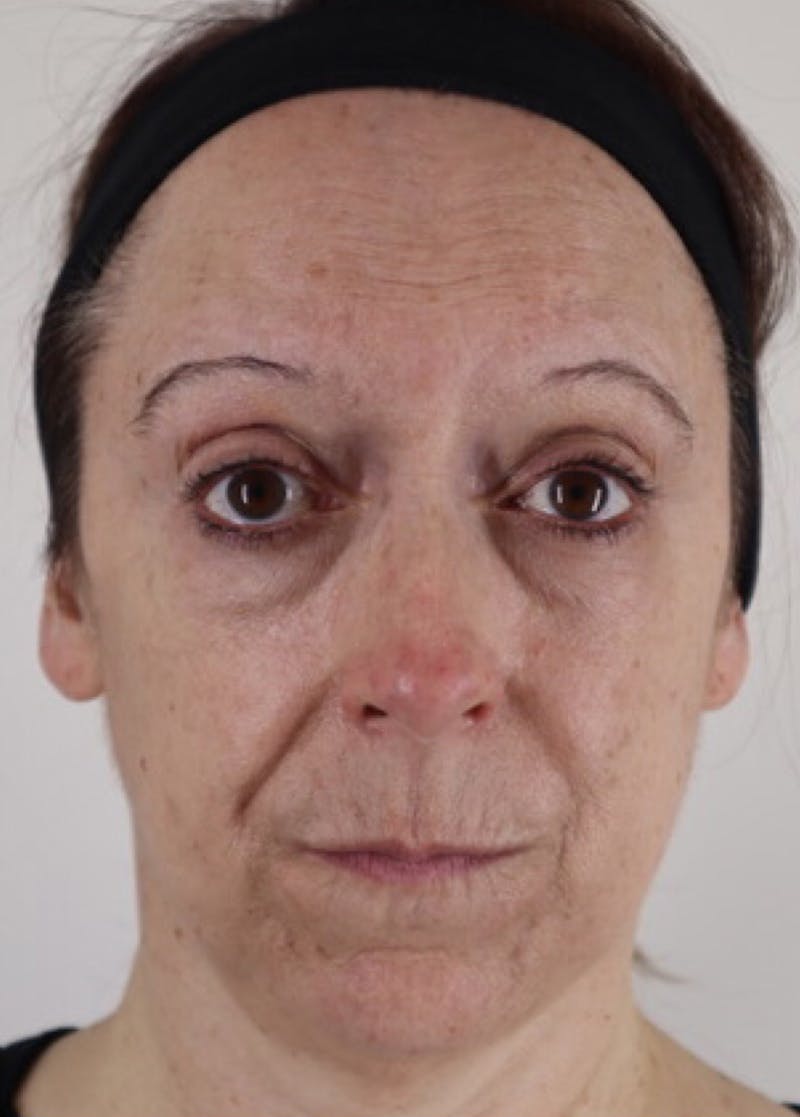 Liquid Lift Before & After Gallery - Patient 87552110 - Image 1
