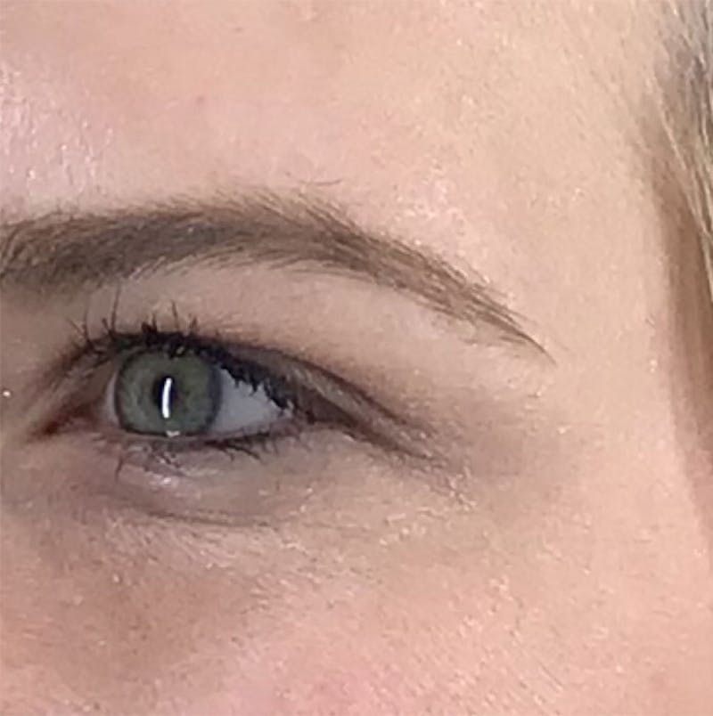 BOTOX Before & After Gallery - Patient 87552106 - Image 10