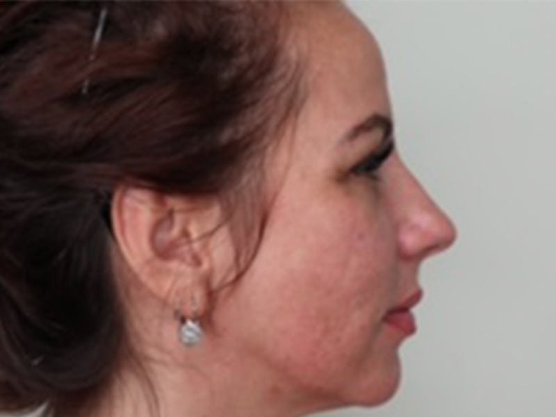 Lip Filler Before & After Gallery - Patient 87552105 - Image 2