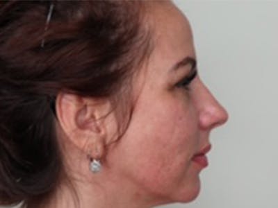 Lip Filler Before & After Gallery - Patient 87552105 - Image 2