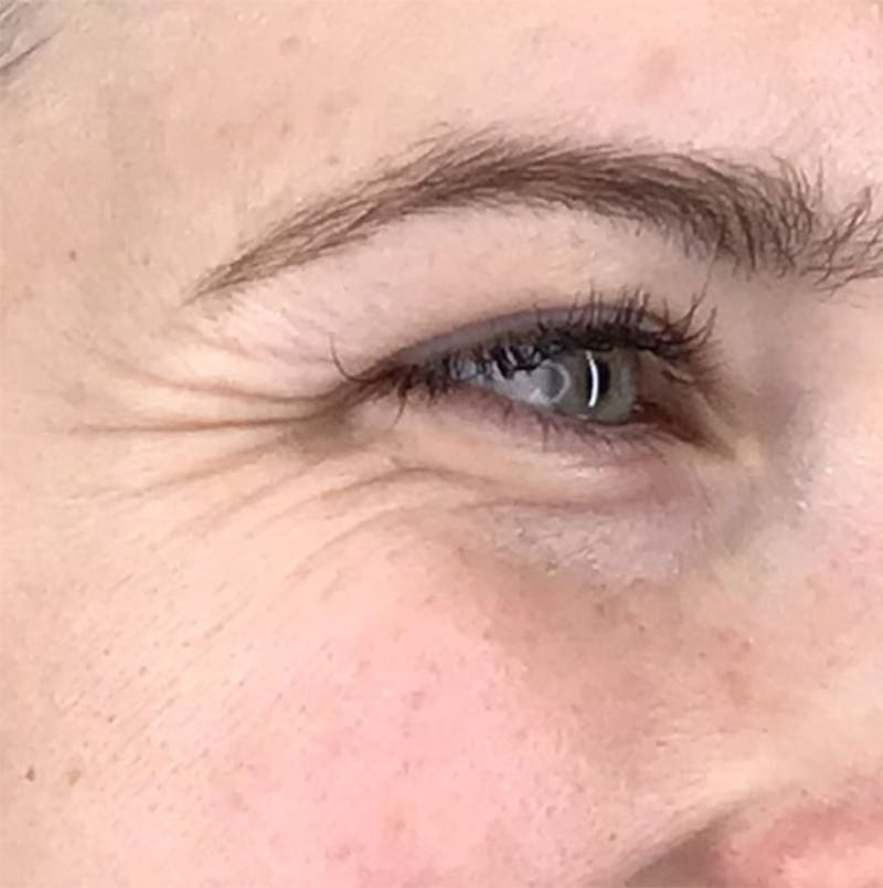 BOTOX Before & After Gallery - Patient 87552106 - Image 11