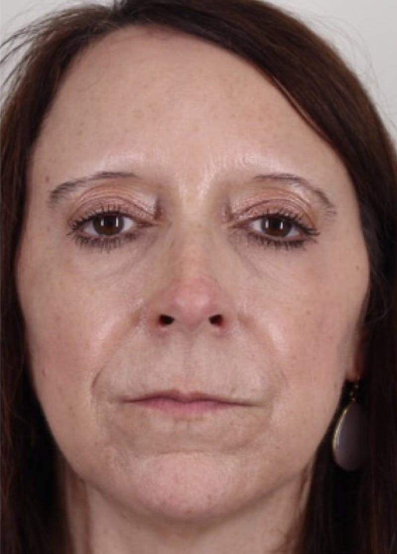 Liquid Lift Before & After Gallery - Patient 87552110 - Image 2