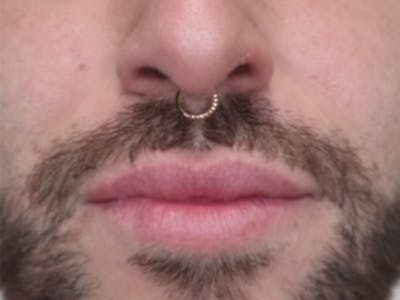 Lip Filler Before & After Gallery - Patient 87552107 - Image 1