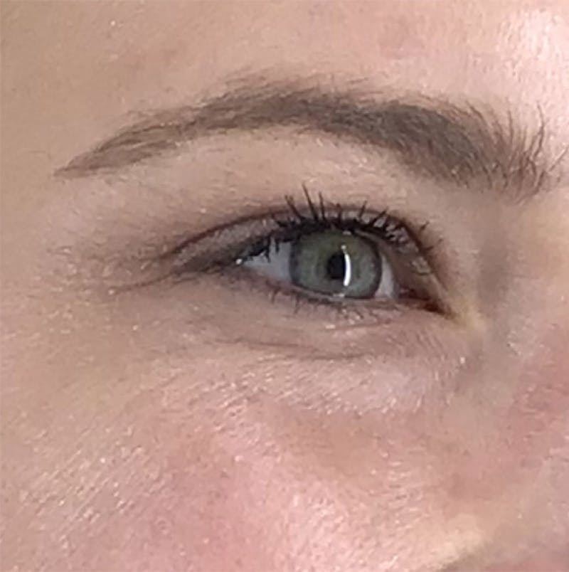 BOTOX Before & After Gallery - Patient 87552106 - Image 12