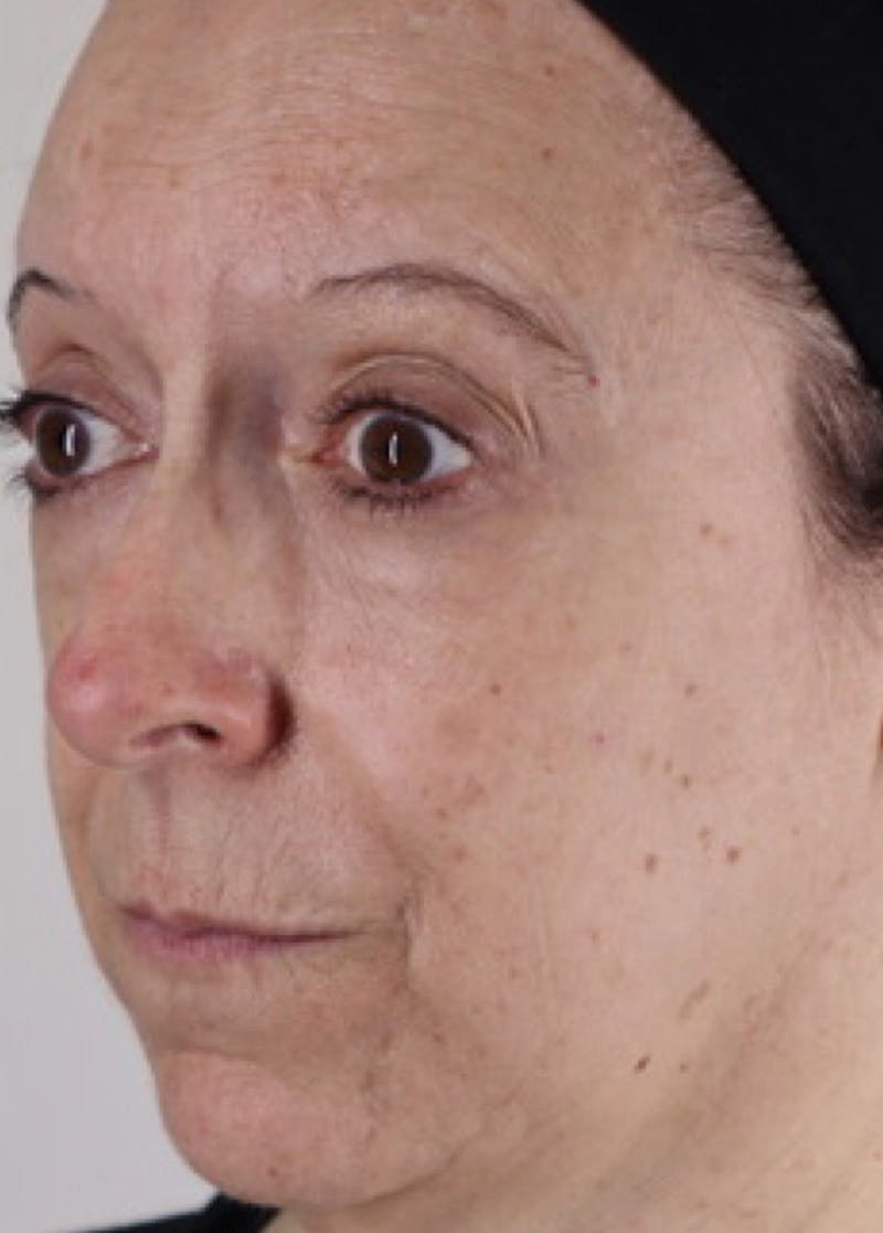 Liquid Lift Before & After Gallery - Patient 87552110 - Image 3