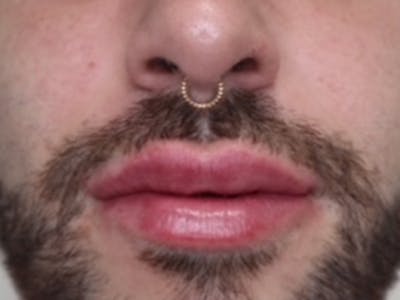 Lip Filler Before & After Gallery - Patient 87552107 - Image 2