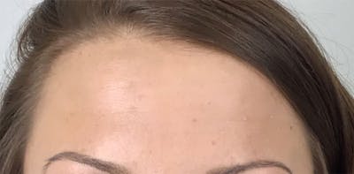 BOTOX Before & After Gallery - Patient 87552109 - Image 1