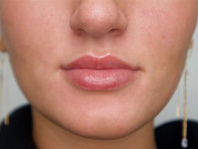 Lip Filler Before & After Gallery - Patient 87552112 - Image 1
