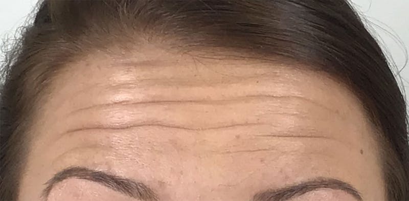 BOTOX Before & After Gallery - Patient 87552109 - Image 2