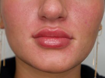 Lip Filler Before & After Gallery - Patient 87552112 - Image 2