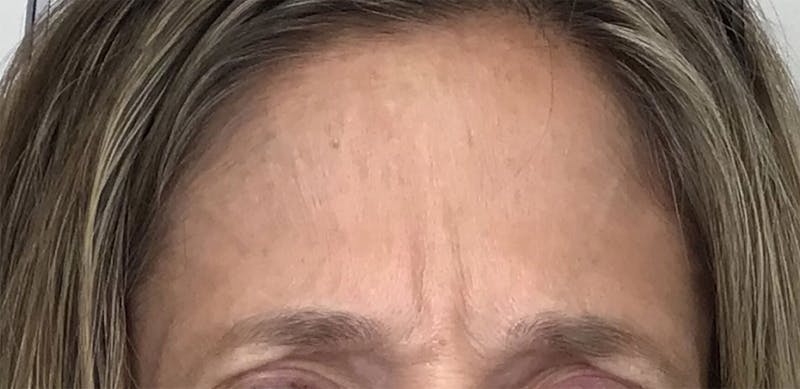 BOTOX Before & After Gallery - Patient 87552113 - Image 1