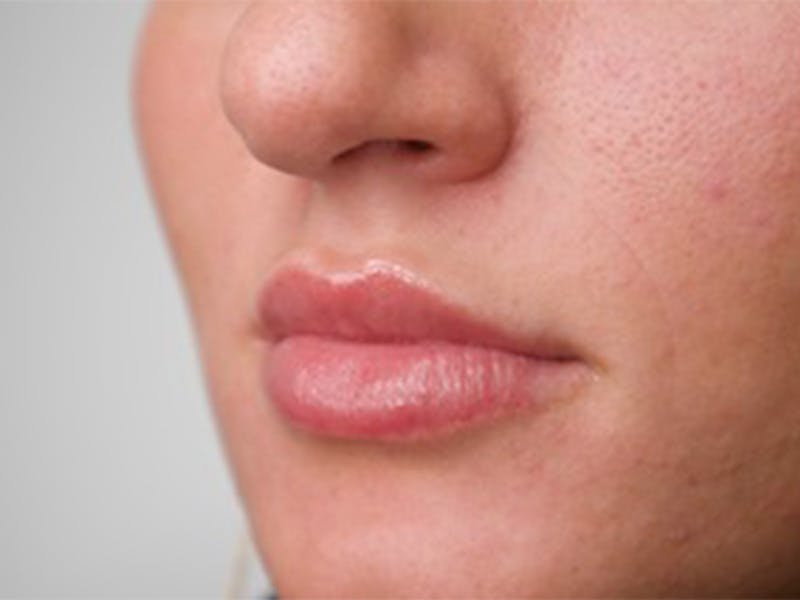 Lip Filler Before & After Gallery - Patient 87552112 - Image 3