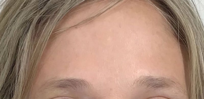 BOTOX Before & After Gallery - Patient 87552113 - Image 2