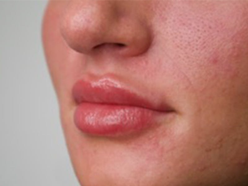 Lip Filler Before & After Gallery - Patient 87552112 - Image 4
