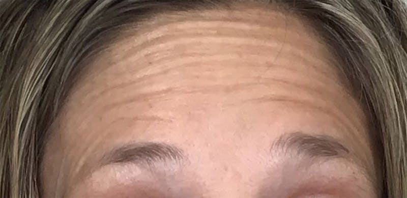 BOTOX Before & After Gallery - Patient 87552113 - Image 3