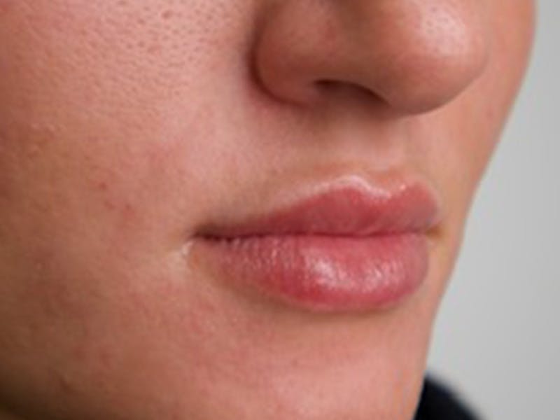 Lip Filler Before & After Gallery - Patient 87552112 - Image 5