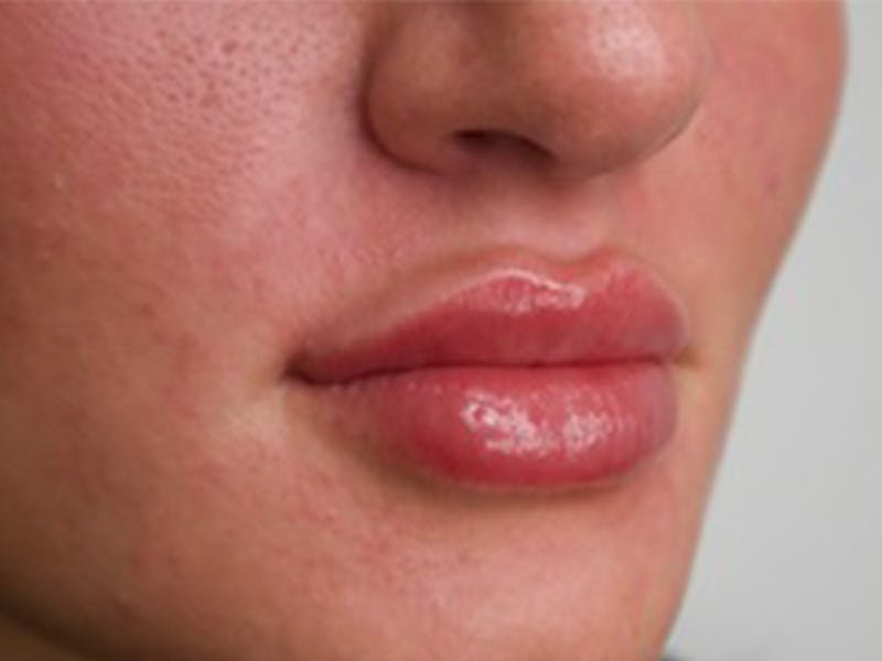 Lip Filler Before & After Gallery - Patient 87552112 - Image 6