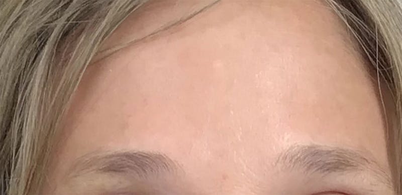 BOTOX Before & After Gallery - Patient 87552113 - Image 4