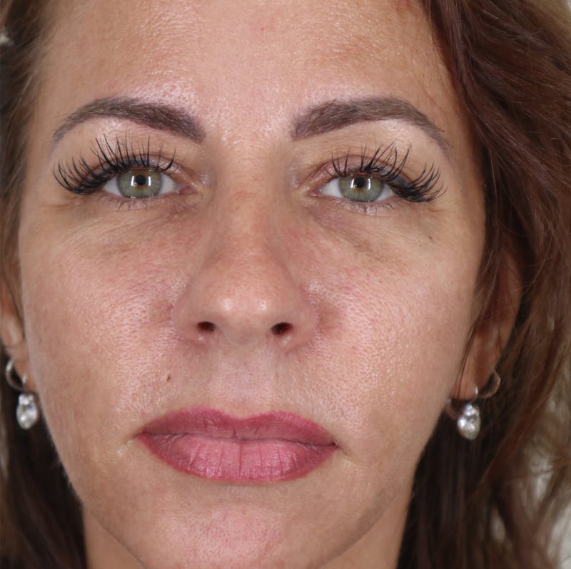 Liquid Lift Before & After Gallery - Patient 87552123 - Image 2