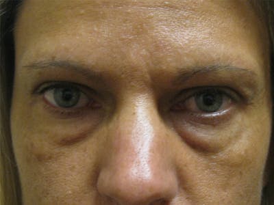 Eyelids Before & After Gallery - Patient 87552117 - Image 1