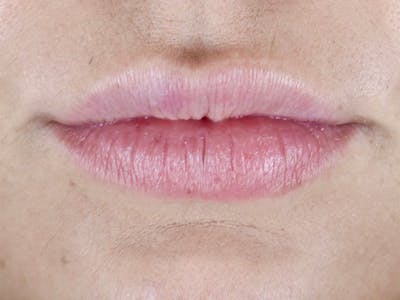 Lip Filler Before & After Gallery - Patient 87552121 - Image 1