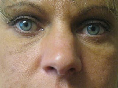 Eyelids Before & After Gallery - Patient 87552117 - Image 2
