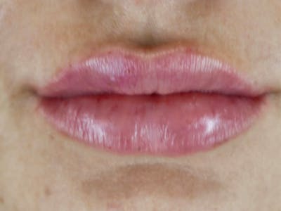 Lip Filler Before & After Gallery - Patient 87552121 - Image 2