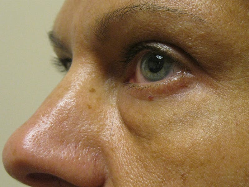 Eyelids Before & After Gallery - Patient 87552117 - Image 3