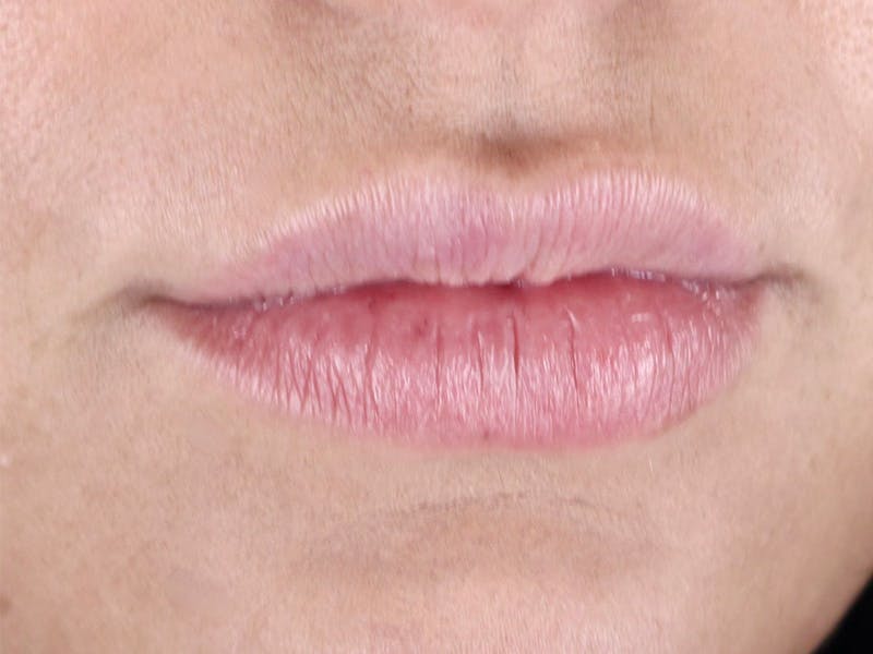 Lip Filler Before & After Gallery - Patient 87552121 - Image 3
