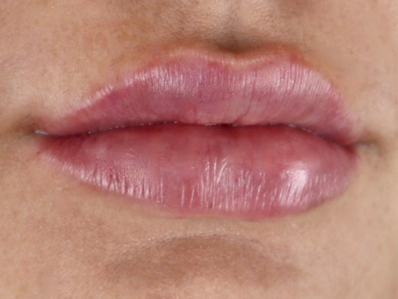 Lip Filler Before & After Gallery - Patient 87552121 - Image 4