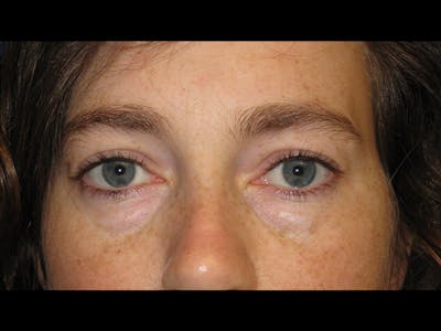 Eyelids Before & After Gallery - Patient 87552120 - Image 1