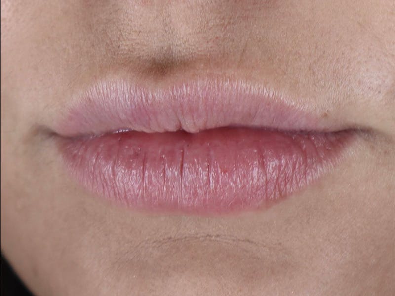 Lip Filler Before & After Gallery - Patient 87552121 - Image 5