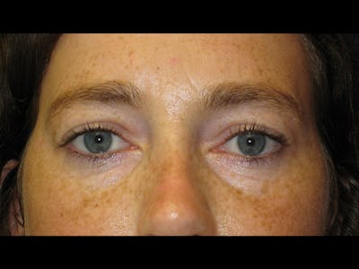 Eyelids Before & After Gallery - Patient 87552120 - Image 2