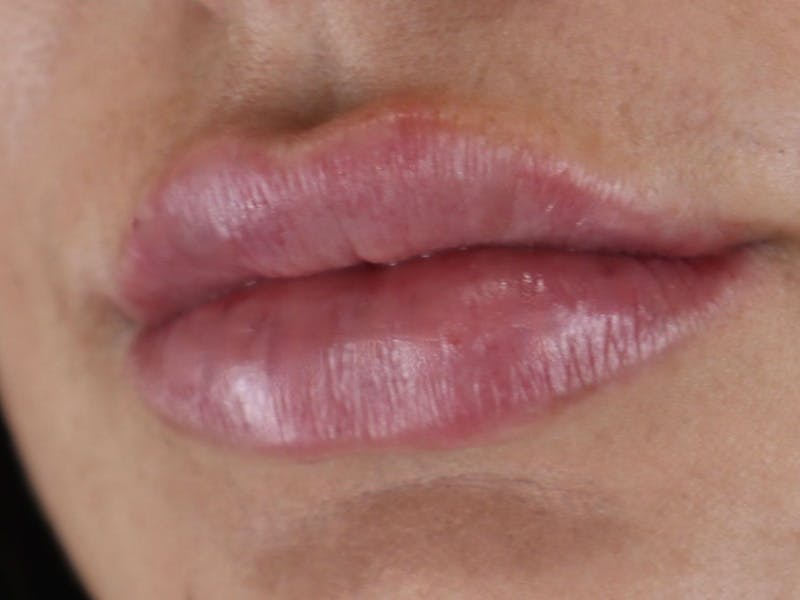 Lip Filler Before & After Gallery - Patient 87552121 - Image 6
