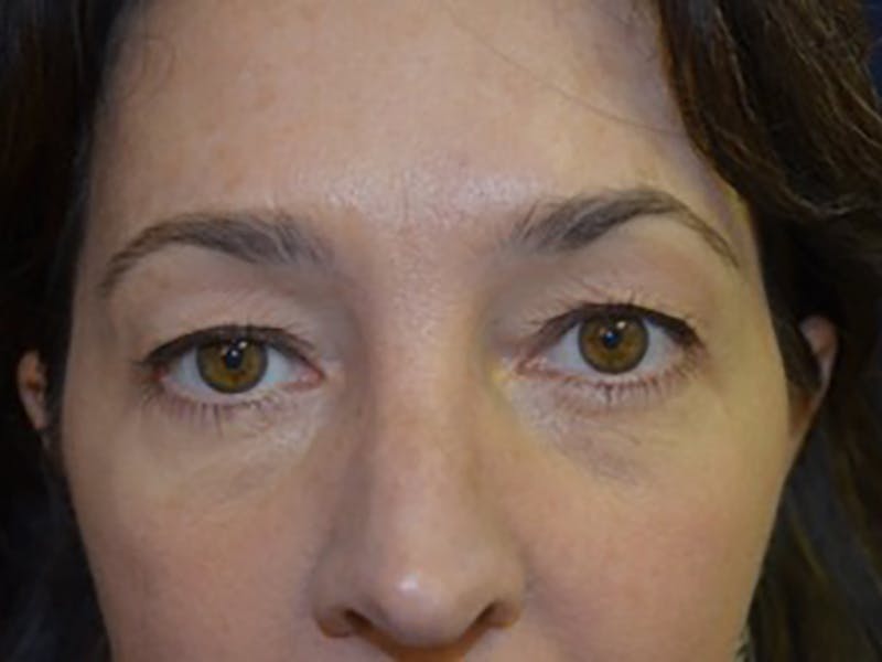 Eyelids Before & After Gallery - Patient 87552128 - Image 1