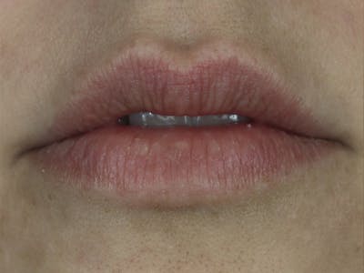Lip Filler Before & After Gallery - Patient 87552126 - Image 1